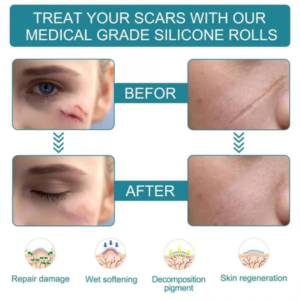 Scarlix Tape by Marketfuse – Fast & Painless Scar Removal Solution At Home