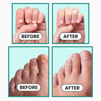 ClearNail Pro™ Nail Fungus Laser Device
