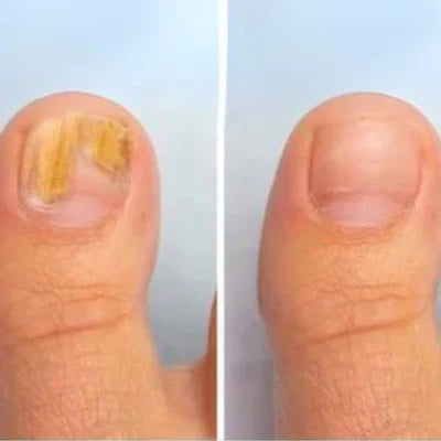 ClearNail Pro™ Nail Fungus Laser Device