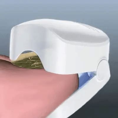 ClearNail Pro™ Nail Fungus Laser Device