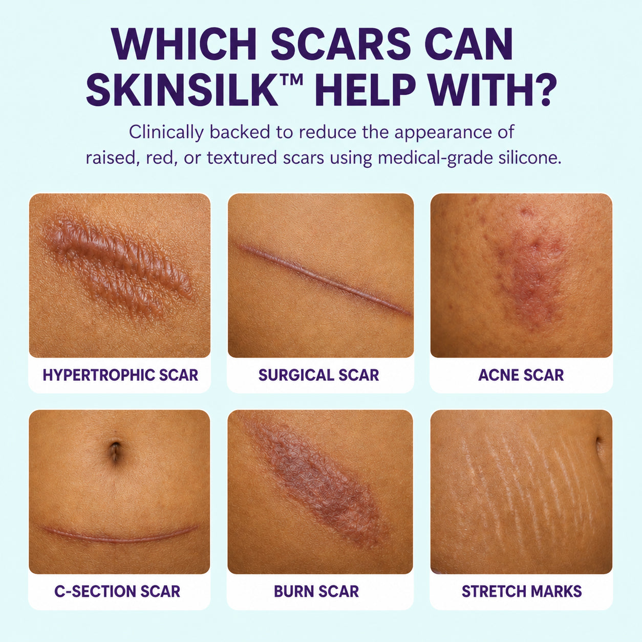SkinSilk™ Tape