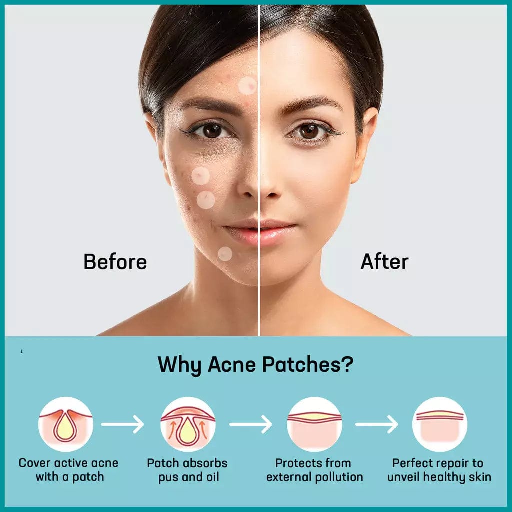 Acne Patch - Pack Of 36 Patches