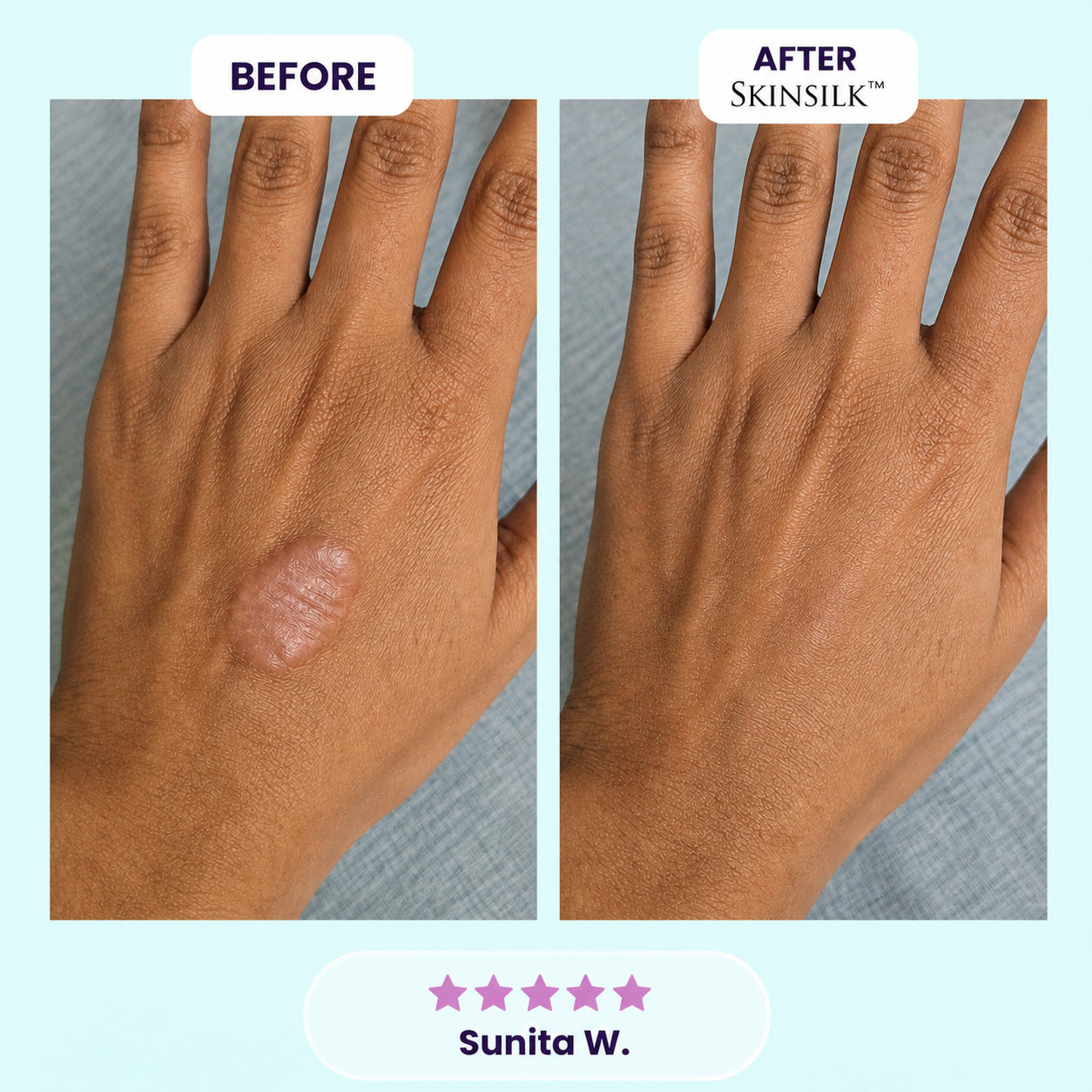 SkinSilk™ Tape